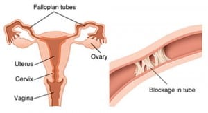 Blocked-Fallopian-Tubes