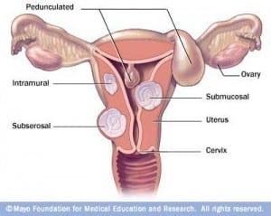 DS00078_ MY00501_IM01586_hdg7_fibroidlocationthu_jpg