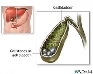 gallbladdersf6