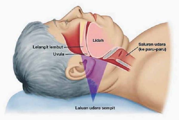 Dengkur membawa maut