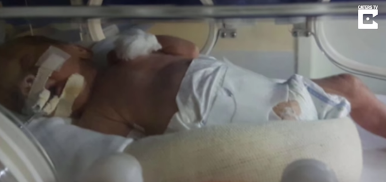Bayi kembar Ini Hidup 123 Hari Di Dalam Kandungan Ibunya Yang Telah Meninggal Dunia... 5