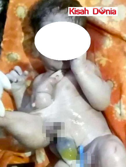 Bayi Lahir Dalam Keadaan Tidak Normal,Penduduk Kampung dan Keluarga Rancang Mahu Buang Bayi Tersebut