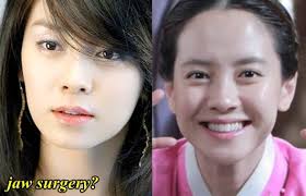 Song Ji Hyo Heboh Dikatakan Pernah Buat Pembedahan Plastik? Ini Dia Penjelasan Dari Pakar Perubatan