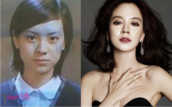 Song Ji Hyo Heboh Dikatakan Pernah Buat Pembedahan Plastik? Ini Dia Penjelasan Dari Pakar Perubatan