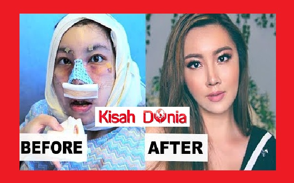 Wanita Ini Kongsi Pengalaman Bagaimana Dia Lalui Proses Pembedahan Plastik Sama Macam Artis Korea Popular Yang Lain Kisah Dunia