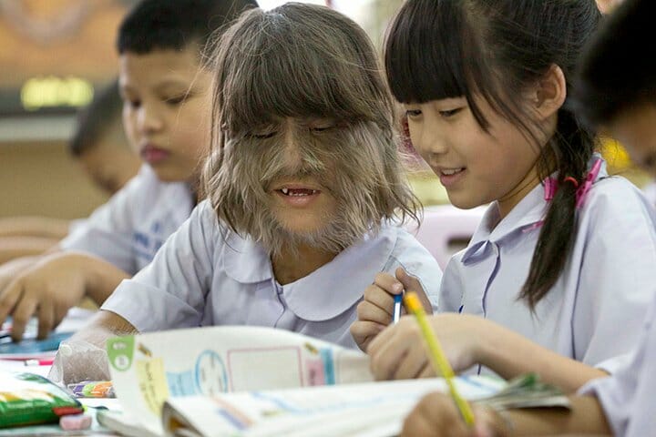 Gadis Wajah Berbulu Akhirnya Membuat Keputusan Untuk Mencukur Bulu Wajah Setelah Bertemu Cinta Sejati