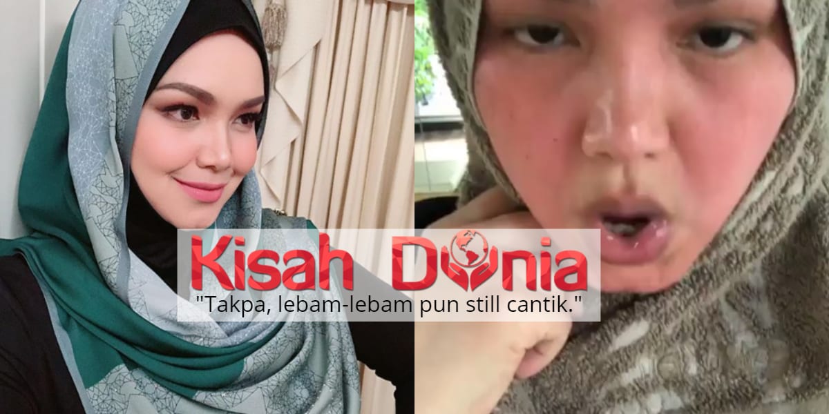 [VIDEO]"Merahnya Muka" - Dato Sri Siti Nurhaliza Kongsi Wajah Lebam Kemerahan 7