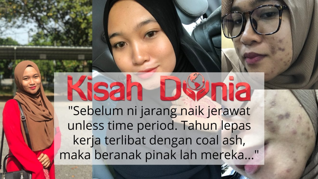 Daripada Parut Berjemaah Muka Gadis Ini Jadi Licin Flawless Apa Rahsia Kisah Dunia