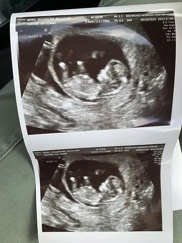 Muntahkan Air Gula Siap Tak Beritahu Nurse, Ibu Terkilan Baby Kembarnya Gugur 4