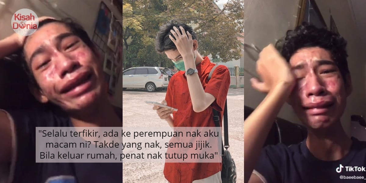 [VIDEO] Insecure Muka Breakout Penuh Parut Jerawat, Pemuda Nangis Down Teruk 4