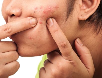 Konon Puas, Rupanya Tabiat Cabut Bulu Hidung & Picit Jerawat Undang Risiko 4 Konon Puas, Rupanya Tabiat Cabut Bulu Hidung & Picit Jerawat Undang Risiko 4