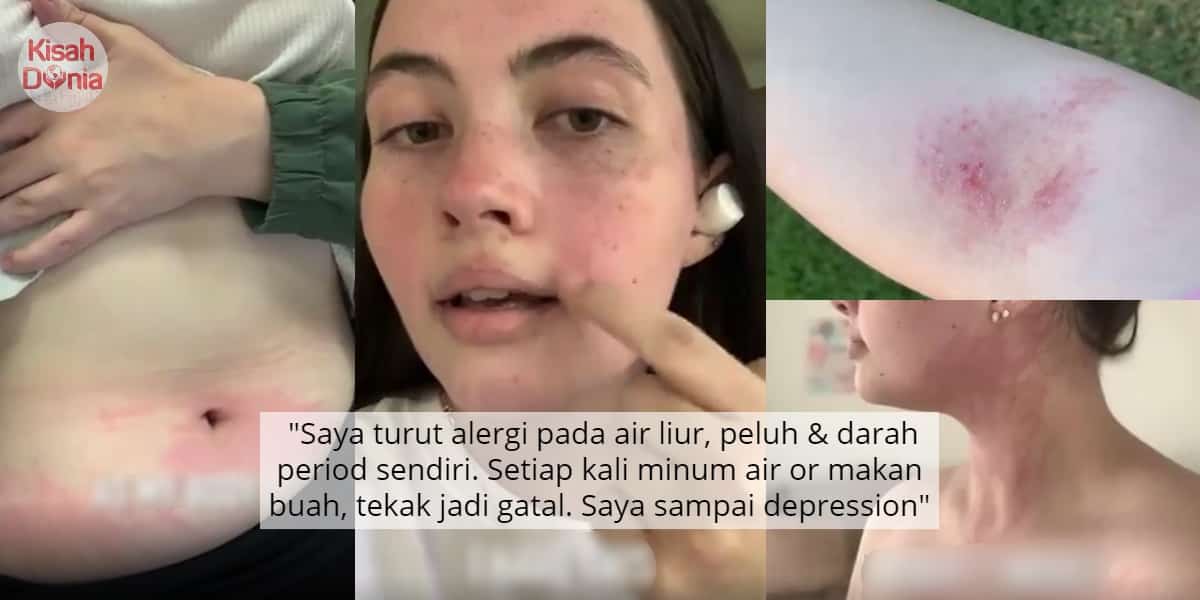 [VIDEO] Alergi Kronik Pada Air, Gadis Derita Cuma Boleh Mandi 2 Bulan Sekali Je 5