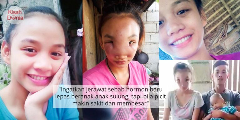 Tabiat Picit Jerawat Undang Padah Muka Ibu Muda Naik Bengkak And Nyaris