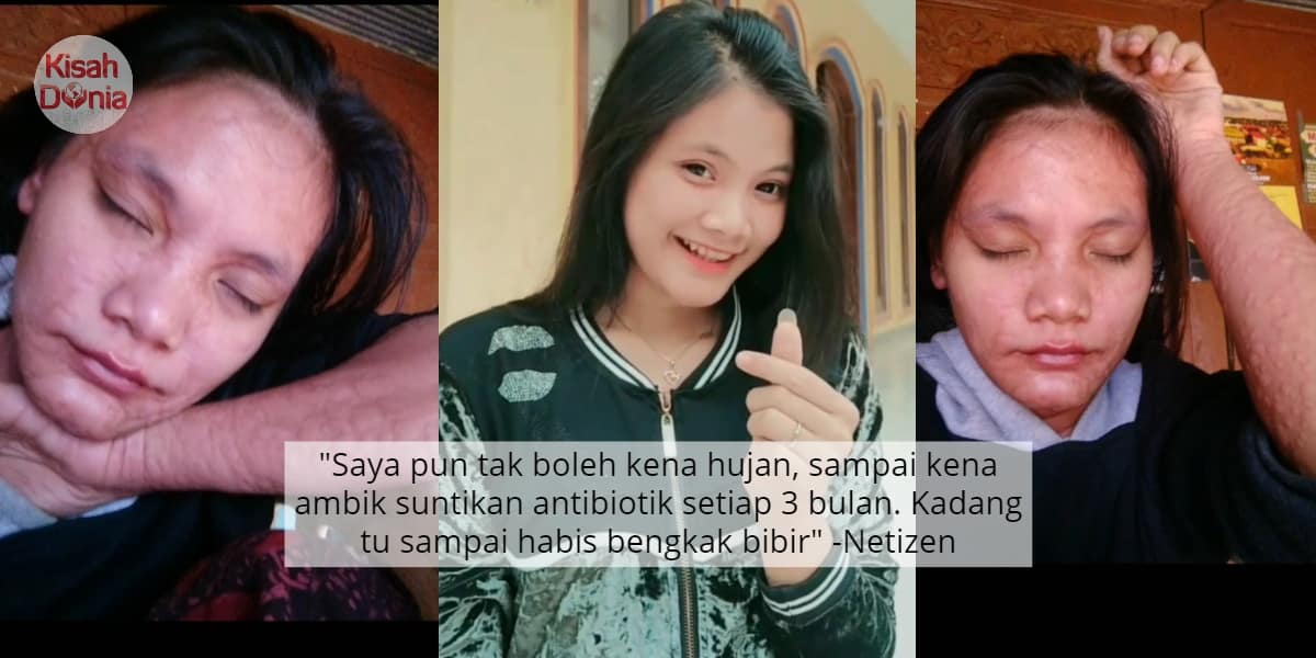 [VIDEO] Trauma Bila Hujan Turun, Gadis Alergi Sampai Naik Gatal & Gelembung Air 2