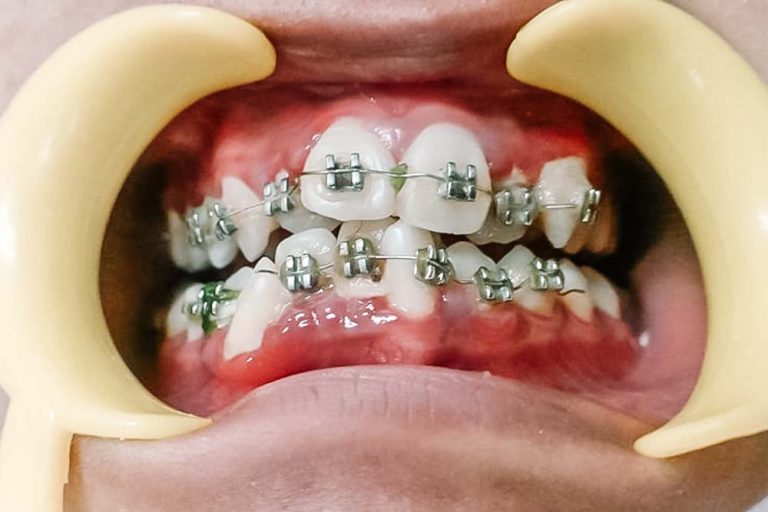 GaraGara Nak Ikut Trend, Ibu Sampai Merayu Doktor Cabut ‘Fake Braces’ Anak Kisah Dunia