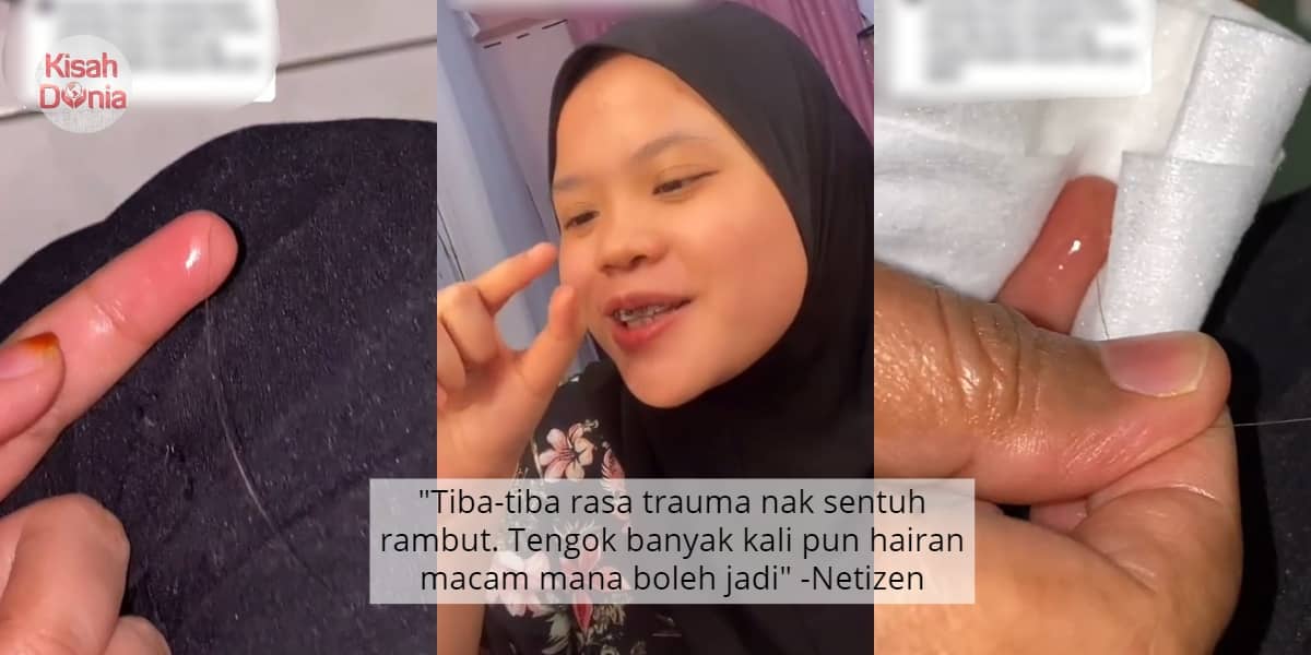 [VIDEO] Rambut Sangkut Dalam Isi Jari, Wanita Cuak Terkena 'Hair Splinter' 5