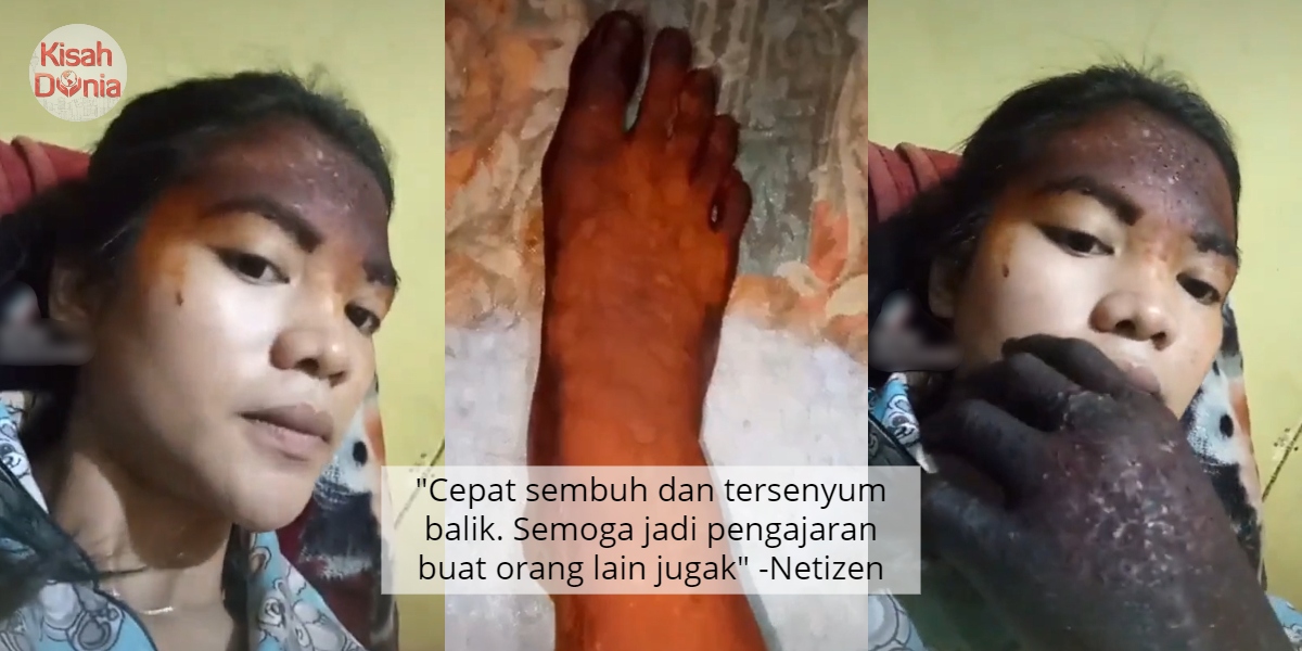 [VIDEO] Disangka Filter, Gadis Dedah Kejadian Sebabkan Separuh Wajah Terbakar 7