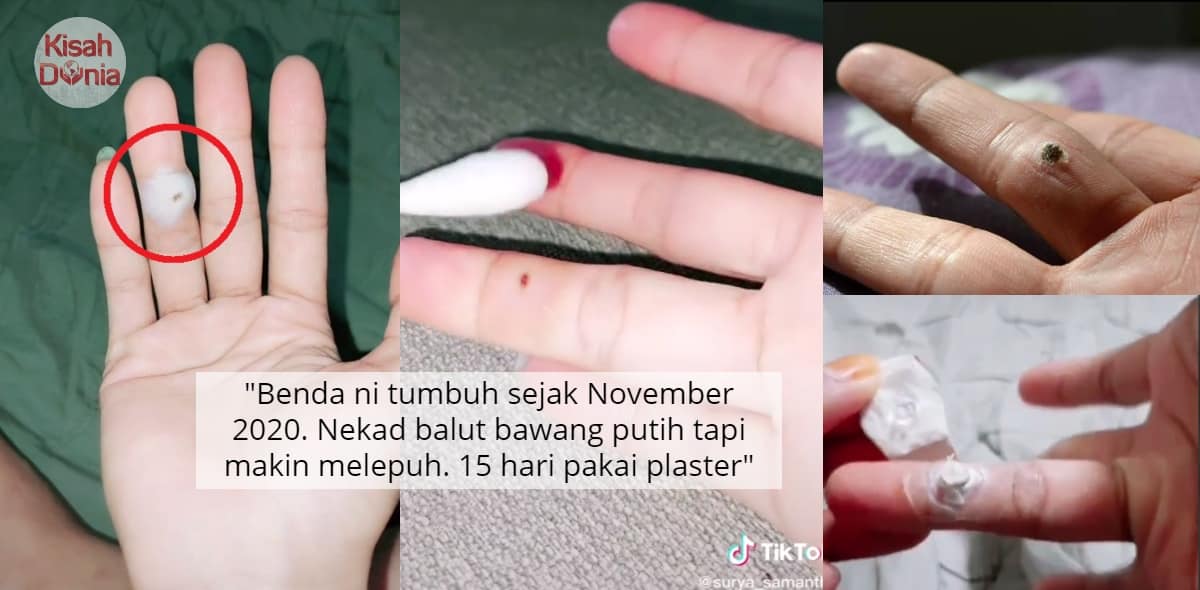 Video Ketuat Tumbuh Di Jari Gadis Insecure Menderita Payah Sangat Nak Sembuh Kisah Dunia