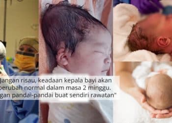 Kepala Bayi Baru Lahir Jadi Lonjong Lepas Vakum, Doktor Pesan Jangan Main Tekan