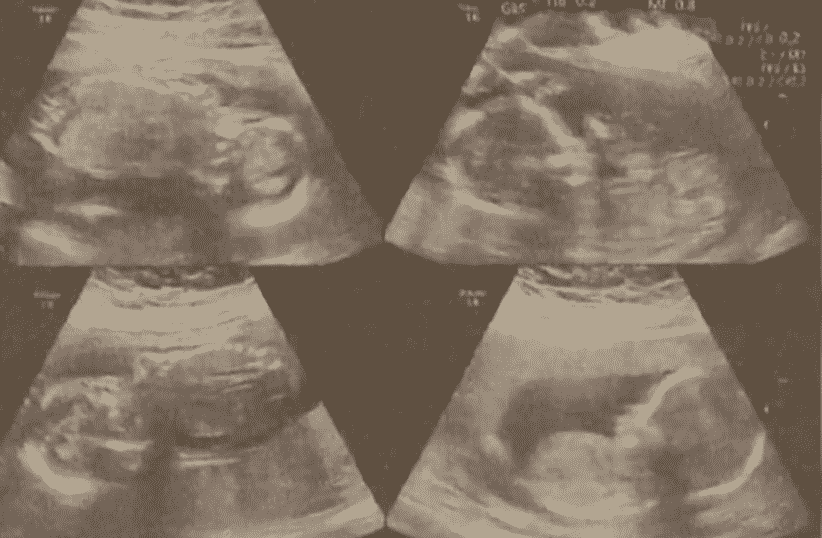 Wanita Hamil Kembar 4 Lahirkan Awal 2 Bayi, Doktor Terpaksa Tangguh Selebihnya 4