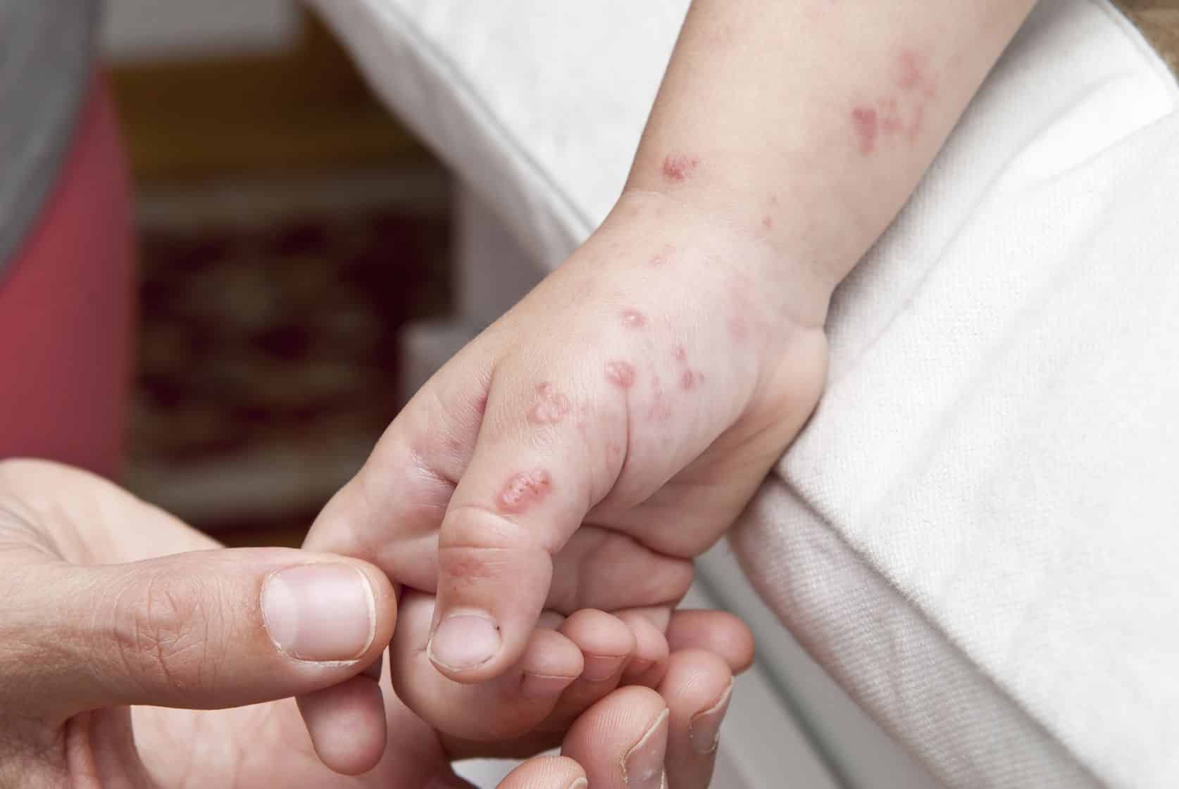 Monkeypox Dah Muncul Di Malaysia? Doktor Tegur Jangan Cetus Panik Keterlaluan 2