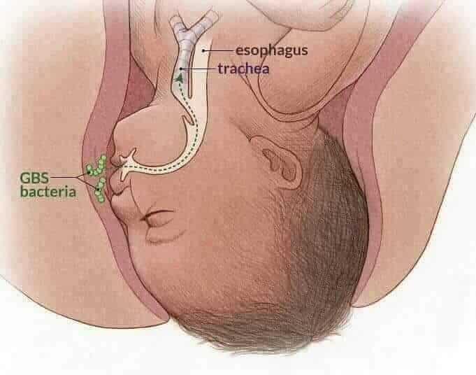 Ibu Beranak Normal Tak Tahu Ada Kuman GBS, Bayi Baru Lahir 1 Jam Dijemput Ilahi 3