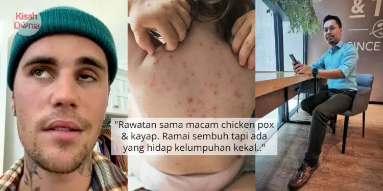 Sindrom Lumpuh Sebelah Muka, Rupanya Semua Penghidap Chicken Pox Boleh Kena