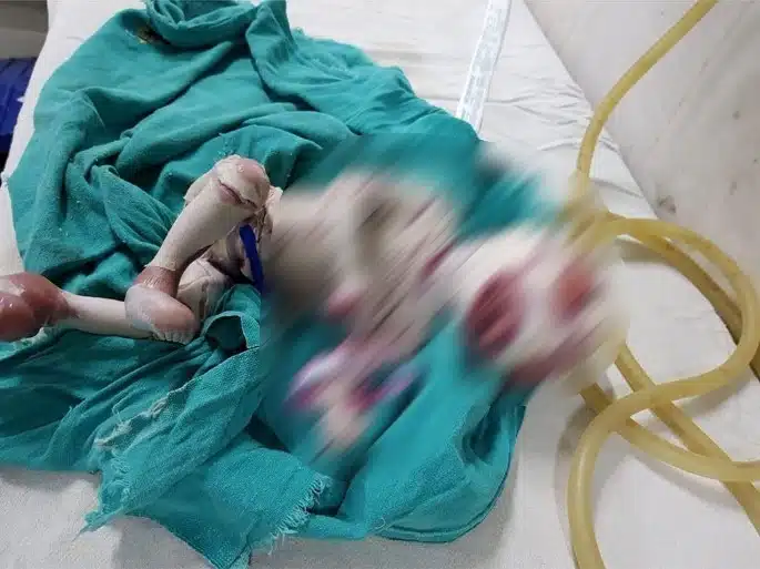 Bayi Hasil Sumbang Mahram, Cuma Sempat Hidup 2 Jam Kerana Kecacatan Genetik