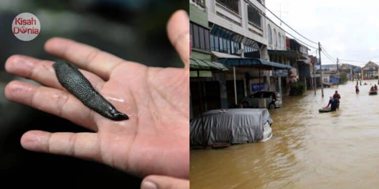 Pundi Kencing Anak Ada ‘Benda’ Bergerak, Rupanya Lintah Masuk Ketika Main Banjir