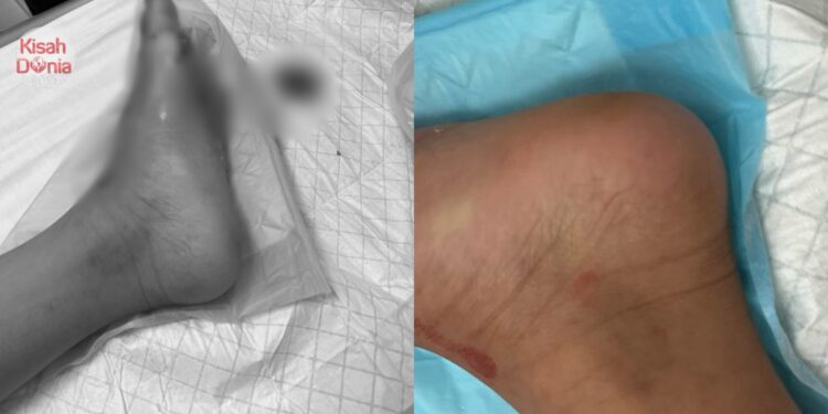 Budak Terima 11 Jahitan, Pihak Villa Tak Beritahu Ada Jubin Pecah Di Kolam Mandi