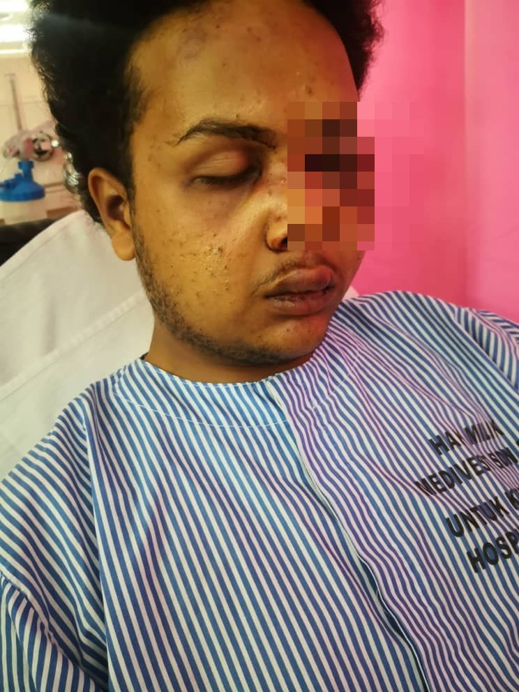 Pemuda Dikeroyok Geng Samseng Hingga Senget Tulang Rahang, Rupanya Silap Orang