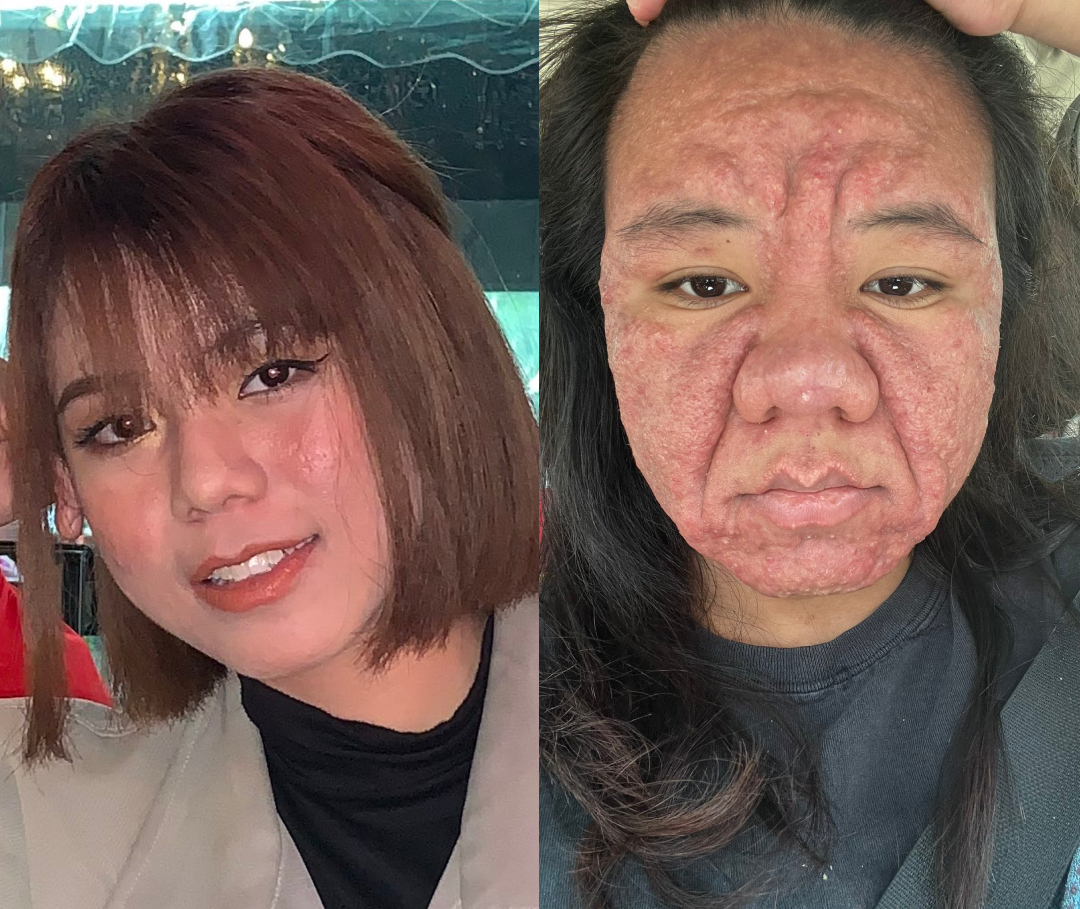 “Makin Dekat Due, Makin Teruk” Wanita Hamil 8 Bulan Alami Perubahan Wajah Ketara
