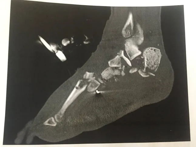 Hilang Kaki Akibat Nahas Jalan Raya, Lelaki Masak & Hidang Pada 10 Rakan
