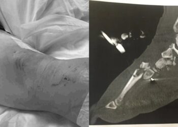 Hilang Kaki Akibat Nahas Jalan Raya, Lelaki Masak & Hidang Pada 10 Rakan