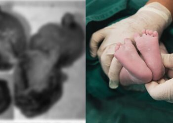 Baru Dilahirkan, Bayi Perempuan Seberat 4.08kg Dikesan ‘Hamil’ 2 Janin Kembar