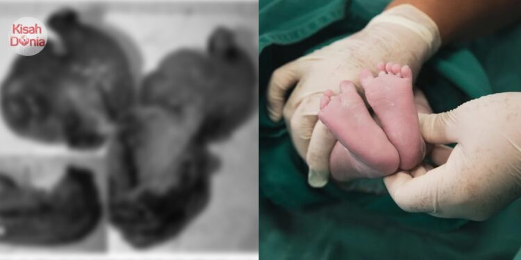 Baru Dilahirkan, Bayi Perempuan Seberat 4.08kg Dikesan ‘Hamil’ 2 Janin Kembar