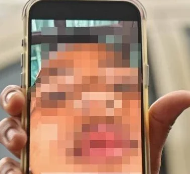 Retak Tulang Mata & Hidung, Budak Darjah 2 Di Terengganu Dianiaya Rakan Sekolah