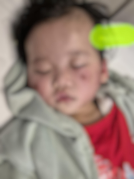 Anak Digigit Budak Lain Di Taska, Polis Suruh Ibu Cari Sendiri Rakaman Kejadian