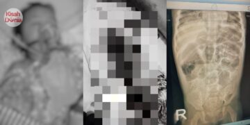 Loya tekak! Doktor keluarkan ‘benda’ ini dari usus lelaki derita sembelit selama bertahun