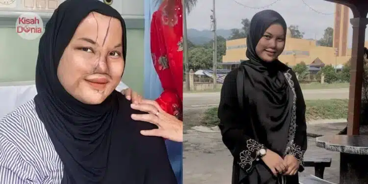 Terkena Percikan Cuka Getah, Anak Maafkan Ayah