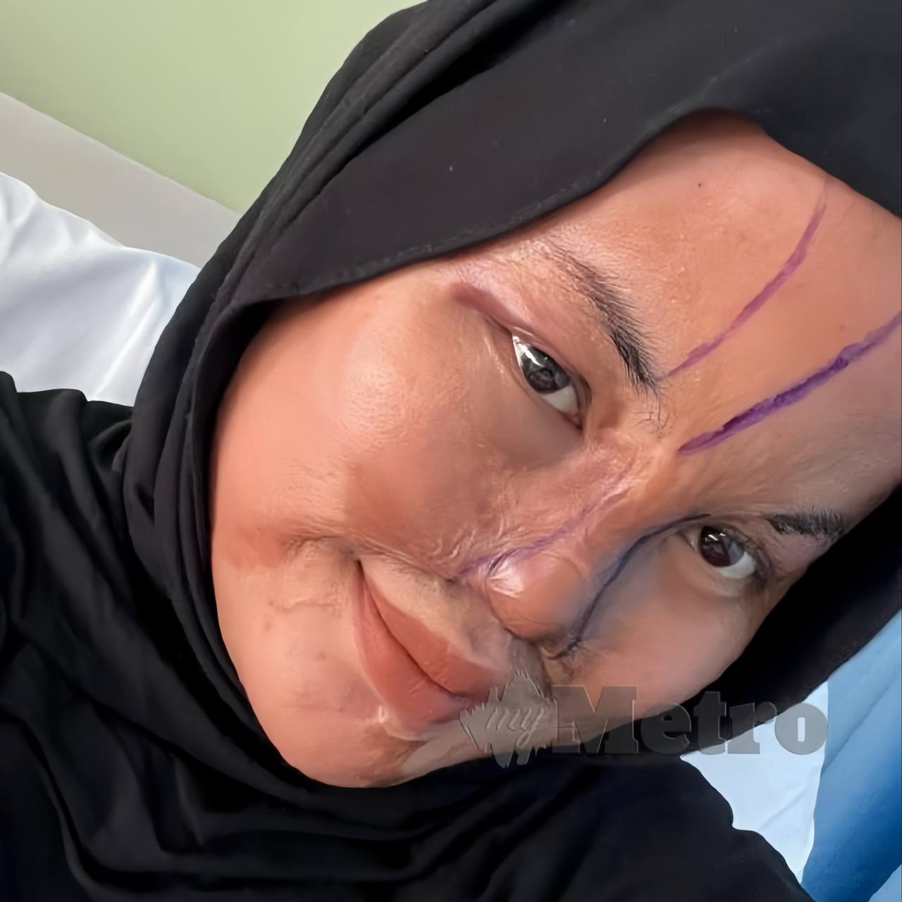 Terkena Percikan Cuka Getah, Anak Maafkan Ayah