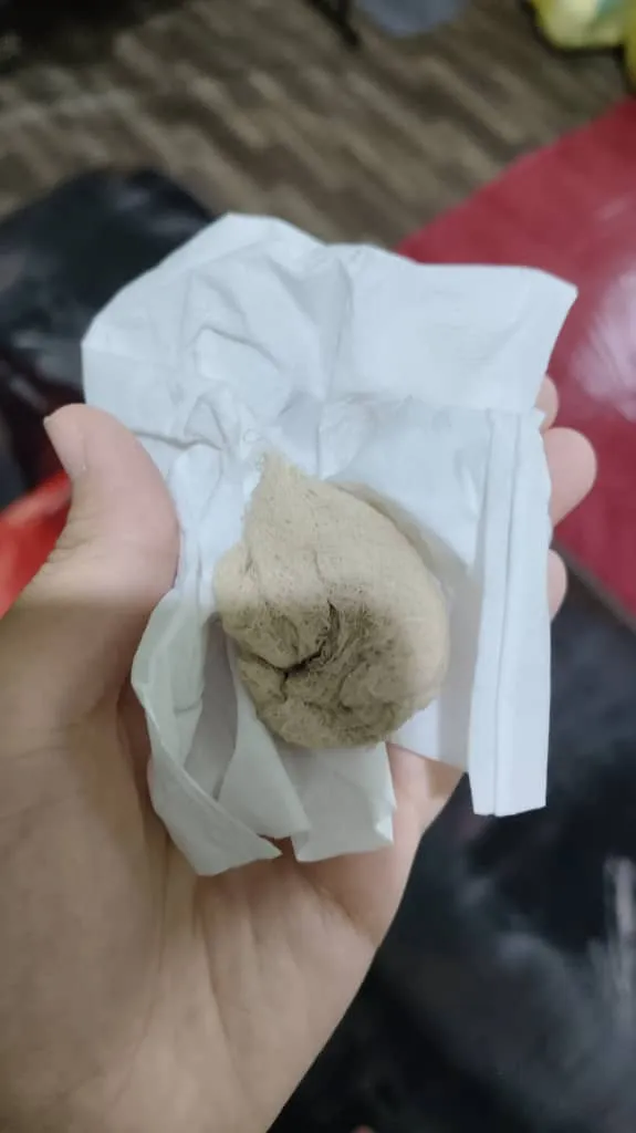 Bersalin Ogos, Ada Benda Putih Masa Kencing, Rupanya Gauze Tercicir Dalam Miss V