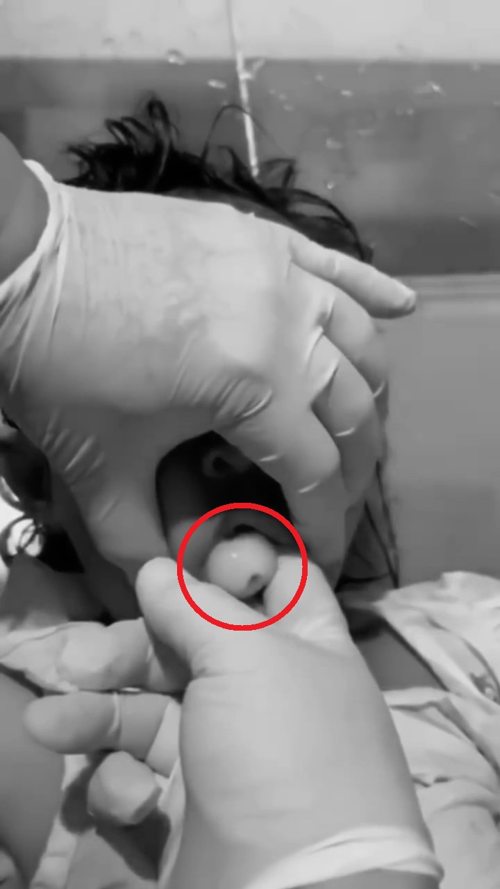 Tersedak Rambutan & Tak Sempat Diselamatkan, Ibu Ratapi Tubuh Kaku Anak 9 Tahun