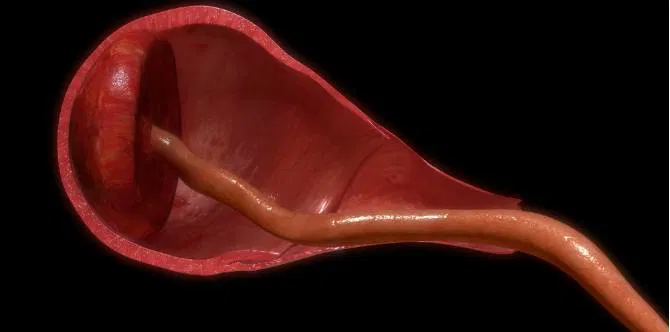 Doktor Terima Plastik Hitam Berisi Rahim Jam 2 Pagi, Uri Wanita Direntap Bidan