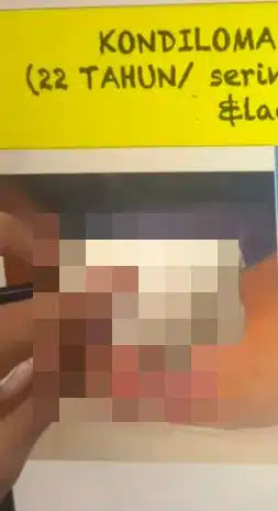 Gadis Umur 16 Kena Kutil Kelamin Di Miss & Belakang, BF Kaki ‘Pesta Songsang’