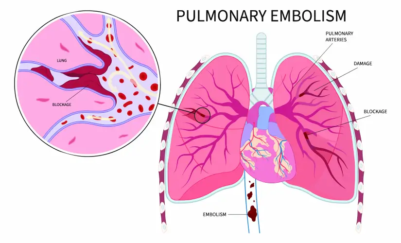 Pergi Salon Lepas 6 Hari Bersalin, Wanita Duduk Terlampau Lama Meninggal Dunia