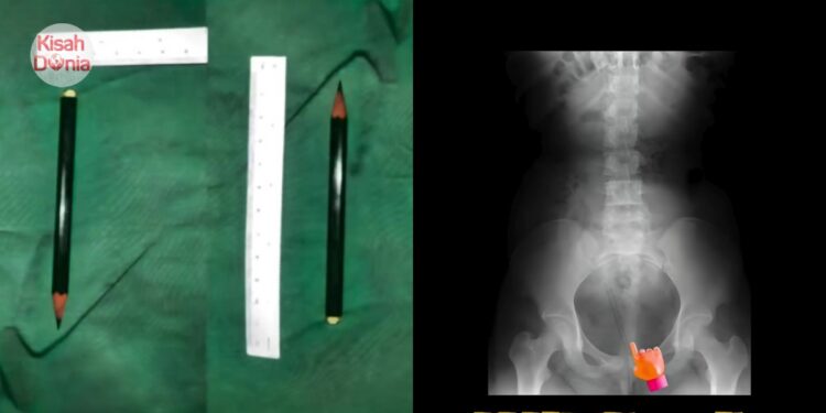 Diejek Kawan Jika Tak Buat, Pensel 10CM Ditemui Di Pundi Kencing Budak 12 Tahun