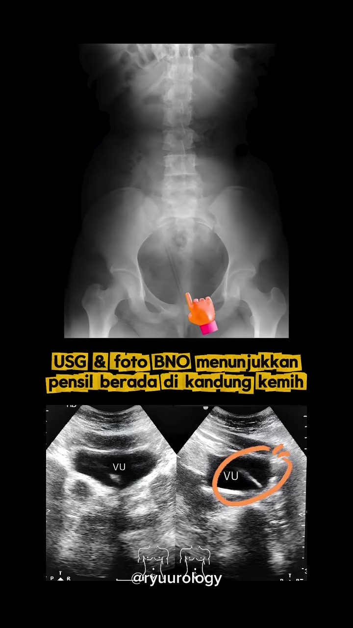 Diejek Kawan Jika Tak Buat, Pensel 10CM Ditemui Di Pundi Kencing Budak 12 Tahun