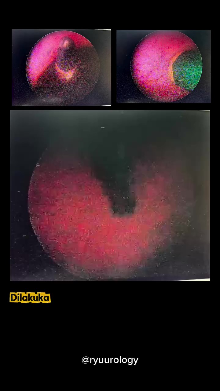 Diejek Kawan Jika Tak Buat, Pensel 10CM Ditemui Di Pundi Kencing Budak 12 Tahun