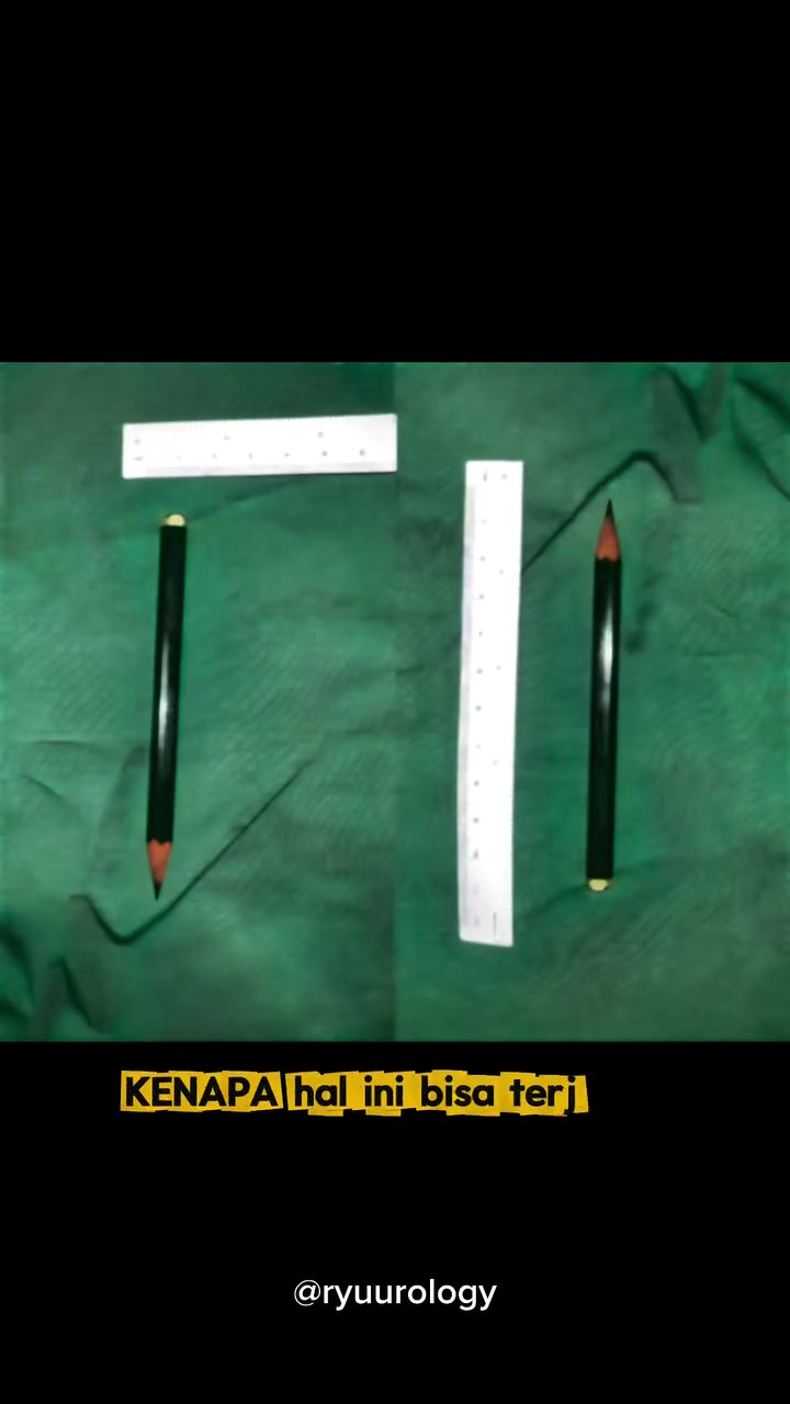 Diejek Kawan Jika Tak Buat, Pensel 10CM Ditemui Di Pundi Kencing Budak 12 Tahun